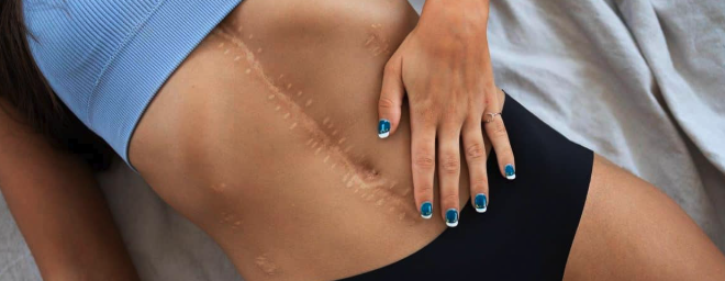 Cicatrização Após Cirurgia Plástica: Como Evitar Queloides e Marcas Indesejadas?